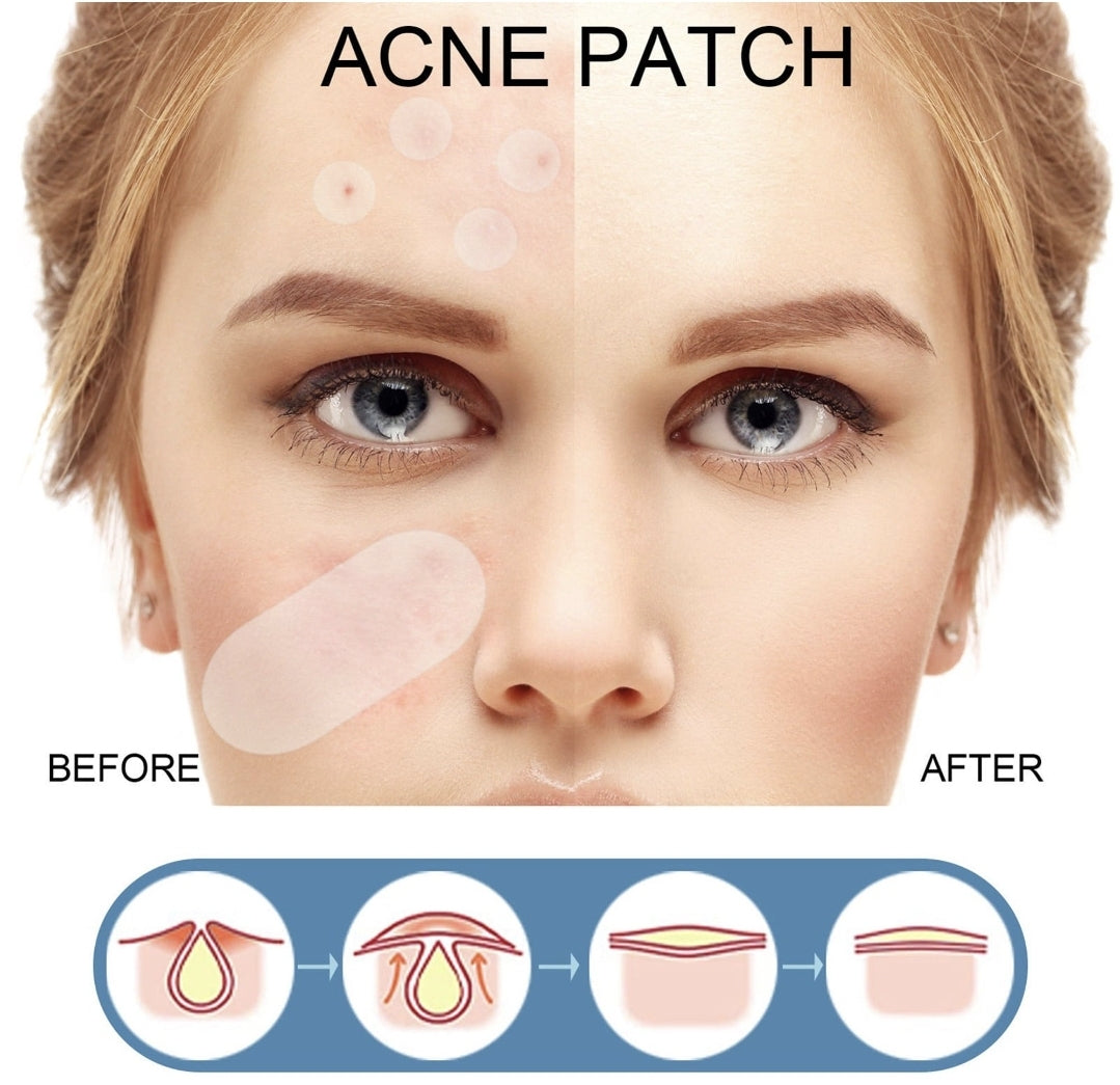 Parche anti acné winner