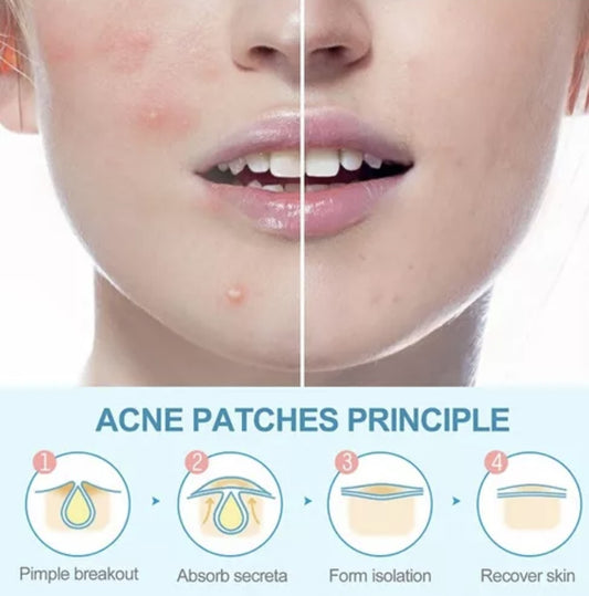 Parche anti acné winner